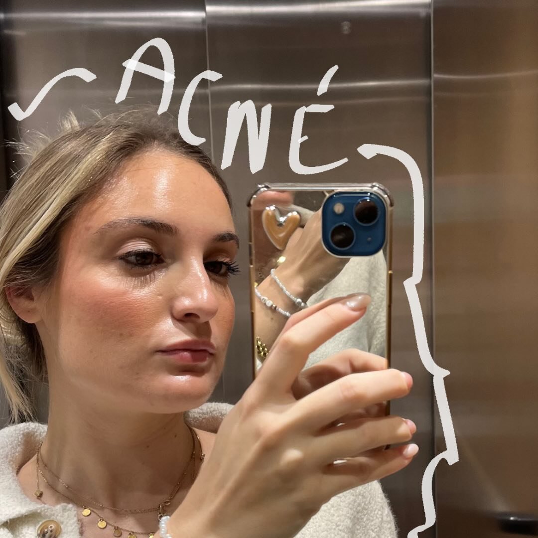 Beatriz Ruiz - Acné