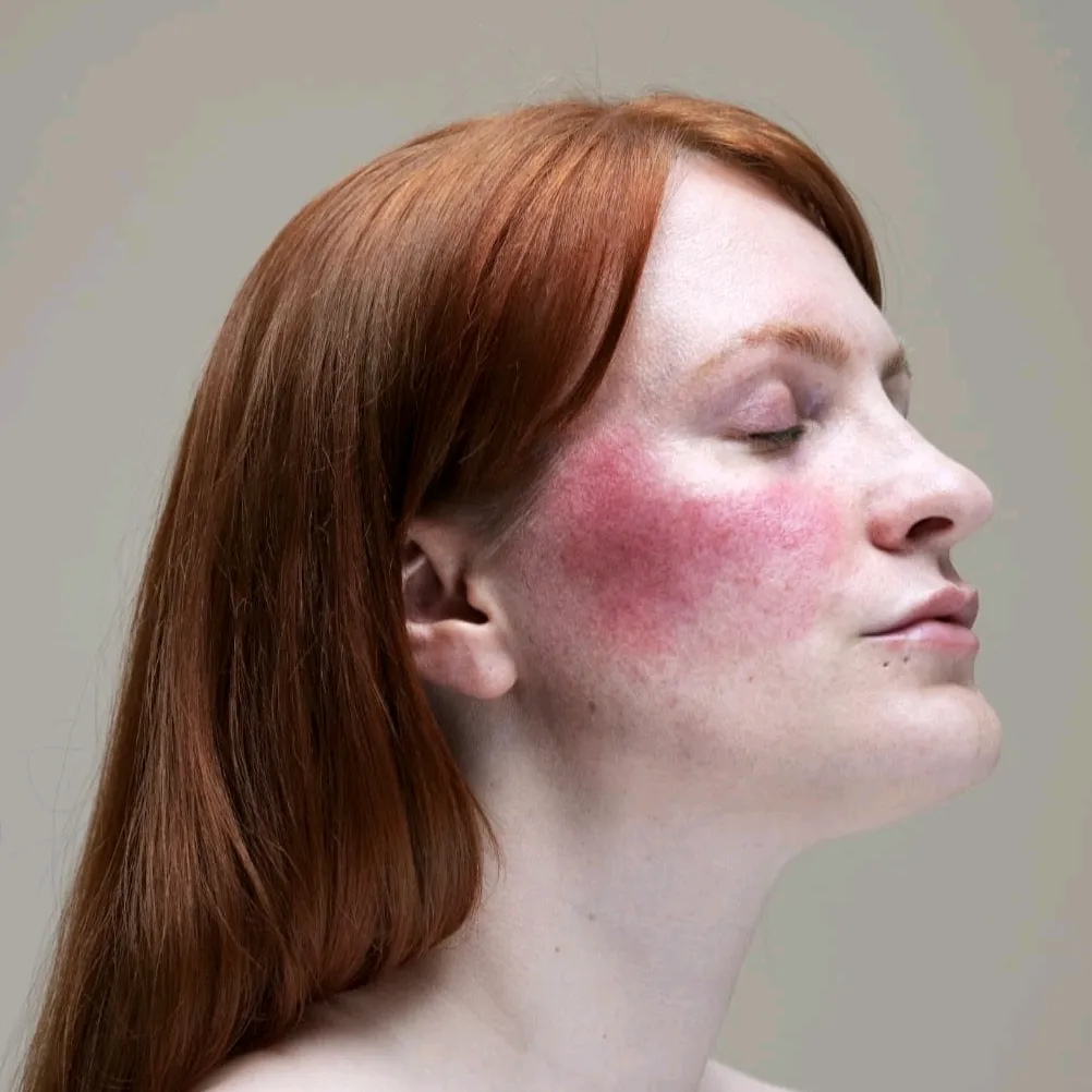 Lex Gillies - Rosacea + Skin Positivity