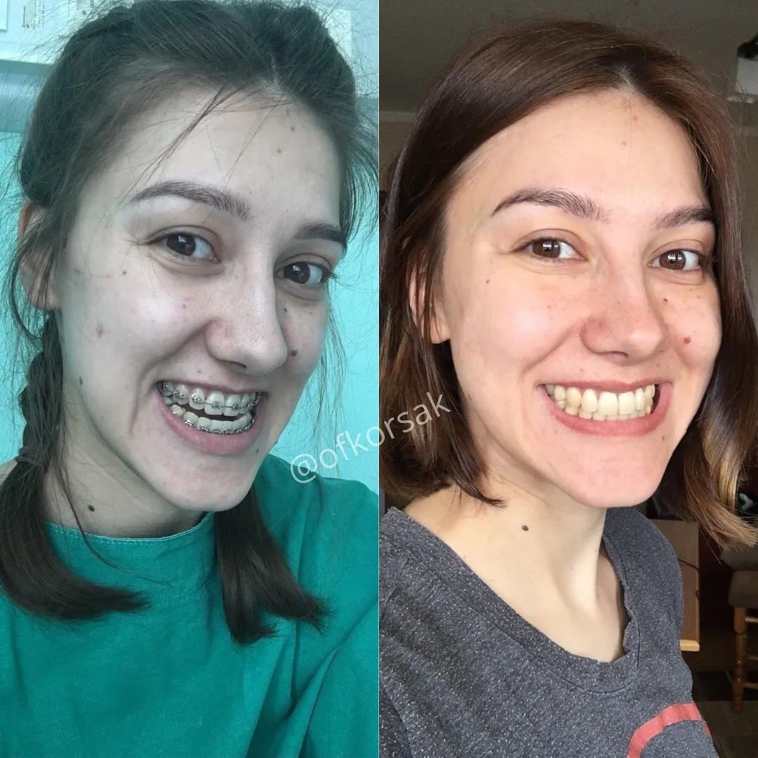 Ofkorsak