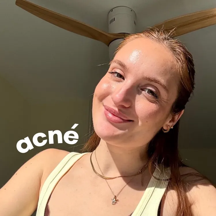 Beatriz Ruiz - Acné