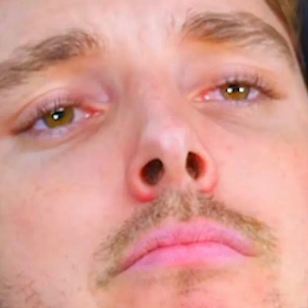 Lazar Beam